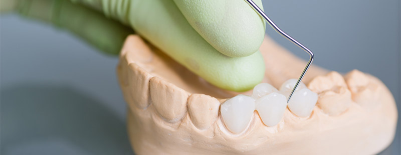 Ein Bild auf dem ein Gebiss gezeigt wird und an einem Zahn mit einer Spitze drauf gezeigt wird